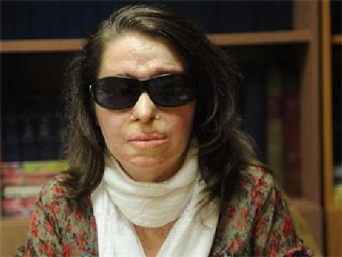 Залятата с киселина в Гърция българка: Революцията е още далече!