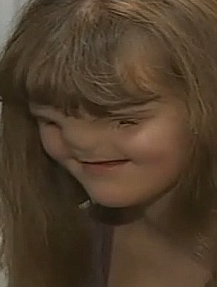 Операция спасява лицето на момичето без очи и нос (ВИДЕО)