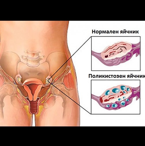 Поликистозни яйчници! Гинеколозите алармират за следните симптоми, които да ви включат червената лампичка