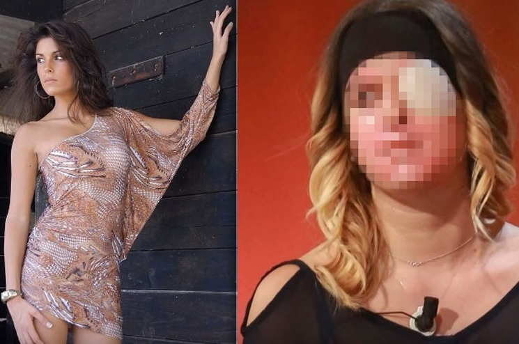 Залятата с киселина кралица на красотата показа обезобразеното си лице (СНИМКИ 18+)