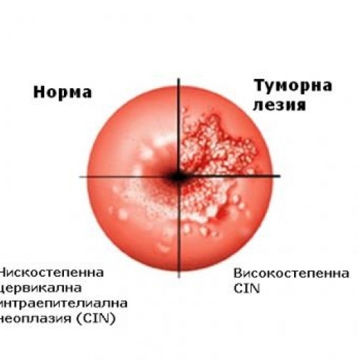 Дами, задължително прочетете тази статия! Ето ги първи симптом на рак на шийката на матката 