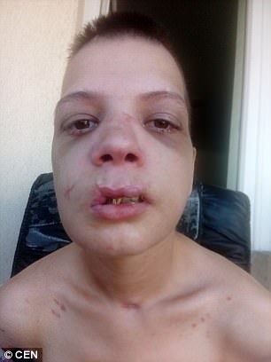 Ужасяващи СНИМКИ (18+): Българска секс робиня показва какво са направили с нея трафиканти на хора 