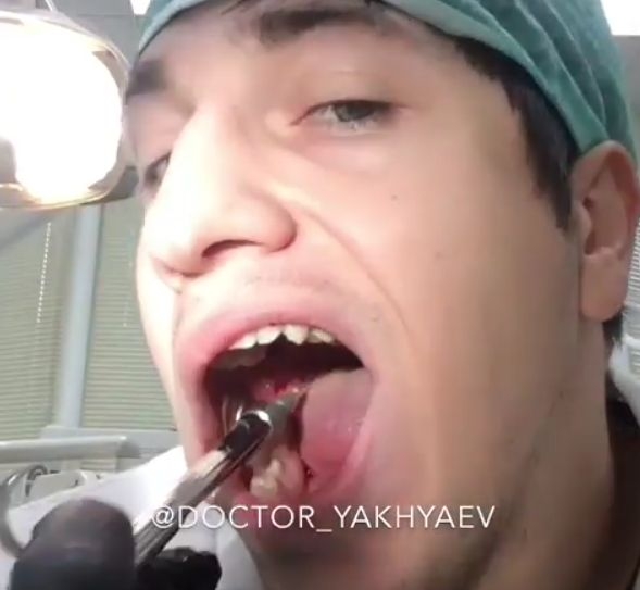 Сръчен зъболекар хвана инструментите и ... сам си извади зъба (ВИДЕО)