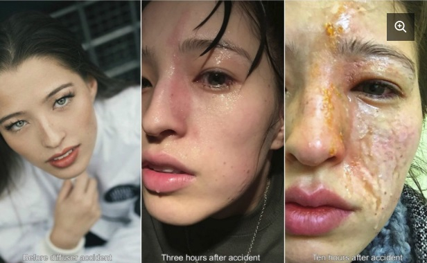 Ужасяващо! Лицето на красива моделка бе изпепелено от етерично пачулиево масло (СНИМКИ 18+)