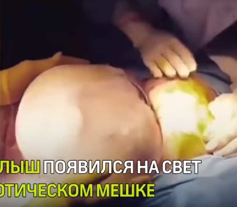 Едно от 800 000 бебета се ражда така, вижте уникалното ВИДЕО (18+)