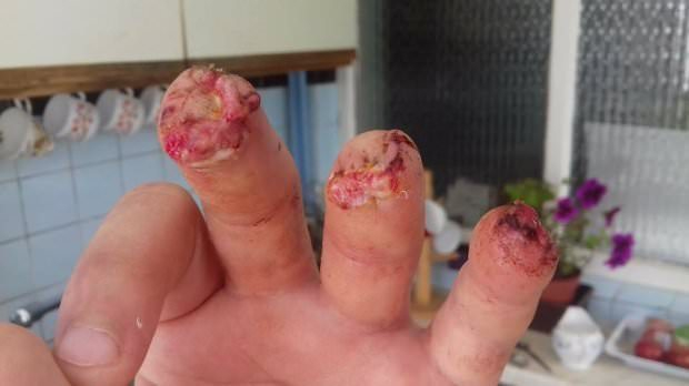 Полицаи случайно отрязаха пръстите на арестант (СНИМКИ/ВИДЕО 18+)