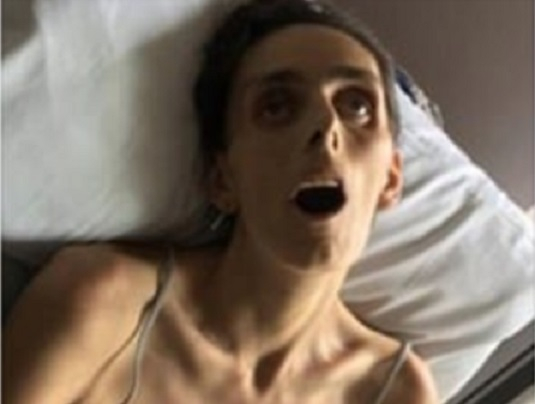 Фейсбук цензурира разтърсваща СНИМКА (18+) на млада жена, умираща от рак 