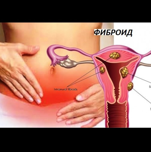 Седем предупредителни признака, че може да имате миома и седем начина да ги смалите естествено