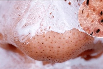 Лесна рецепта за маска от 2 продукта срещу черните точки по лицето