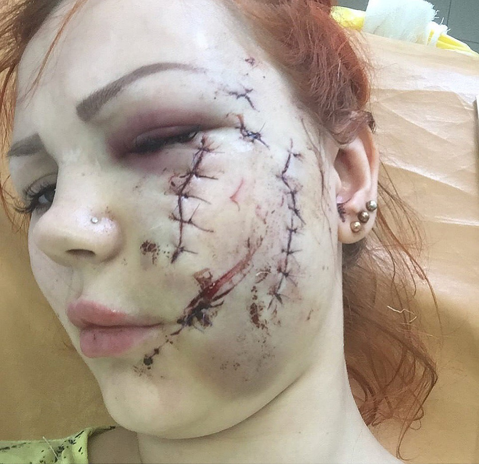 Млада жена отиде да се забавлява в караоке бар, но завърши вечерта в болница с обезобразено лице (СНИМКИ 18+)