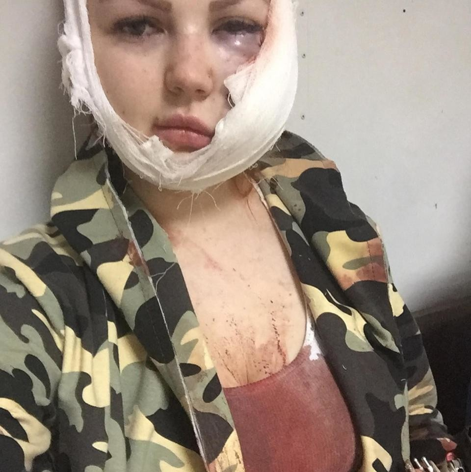 Млада жена отиде да се забавлява в караоке бар, но завърши вечерта в болница с обезобразено лице (СНИМКИ 18+)