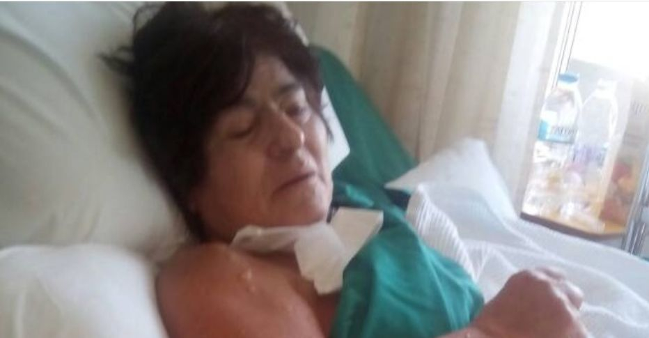 Кошмарна СНИМКА (18+) на обгорялата българка Елена в огнения гръцки ад!
