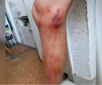 Професорът, наръфан от питбул в „Овча купел“, показа окървавения си крак (ВИДЕО)