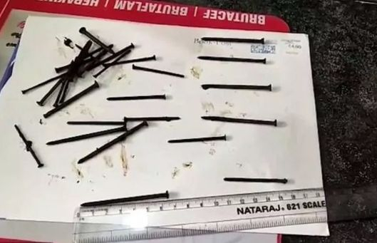 143 пирона извадиха от стомаха на мъж, обичащ да си похапва желязо (СНИМКИ 18+)