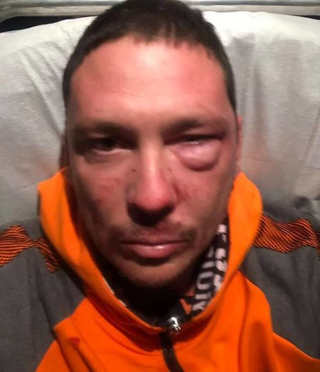 СНИМКА на бившия на Черната Златка с обезобразено лице шокира бургазлии 