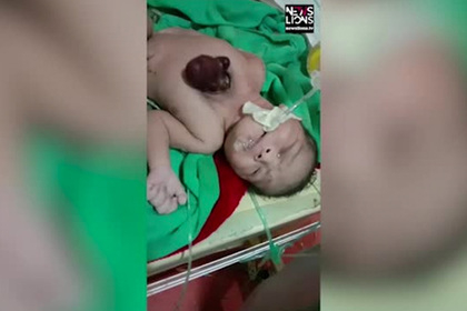 Дете се роди със сърце извън тялото поради рядко заболяване ВИДЕО 18+