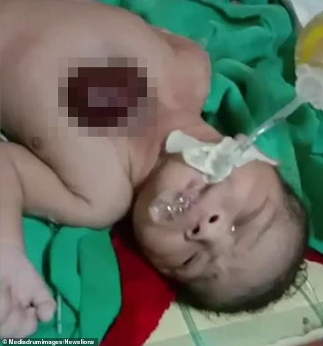 Дете се роди със сърце извън тялото поради рядко заболяване ВИДЕО 18+