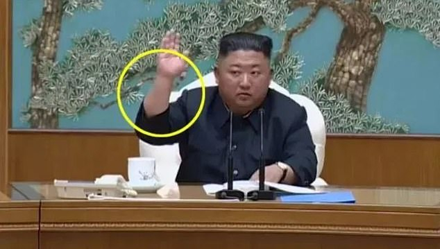 Медици видяха нещо на ръката на Ким Чен Ун и обясниха защо бе изчезнал СНИМКИ