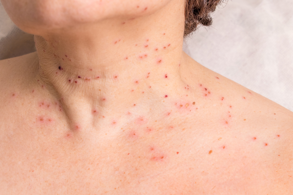 Ето как ефективно да премахнете папиломите по кожата