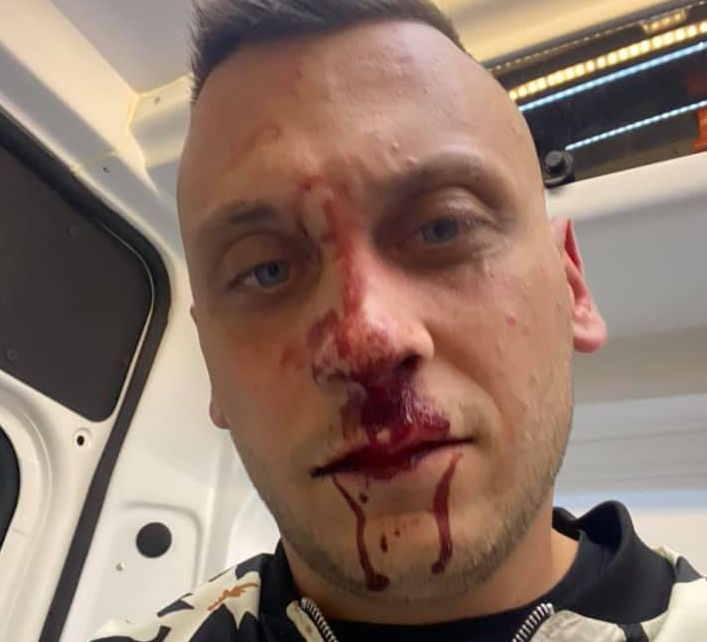 Пребиха брутално известния активист срещу протестите Георги Флоров СНИМКИ 18+ 
