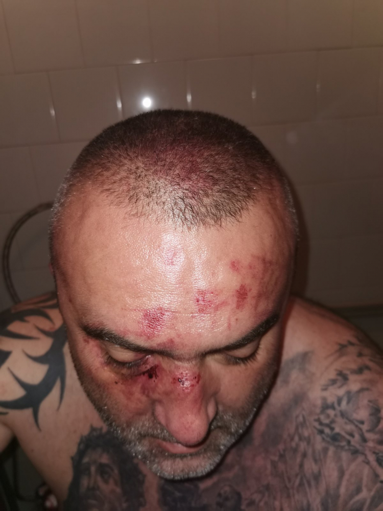 Зловещи подробности за Ради Дългия, пребит брутално от общинар на Марешки ВИДЕО 18+