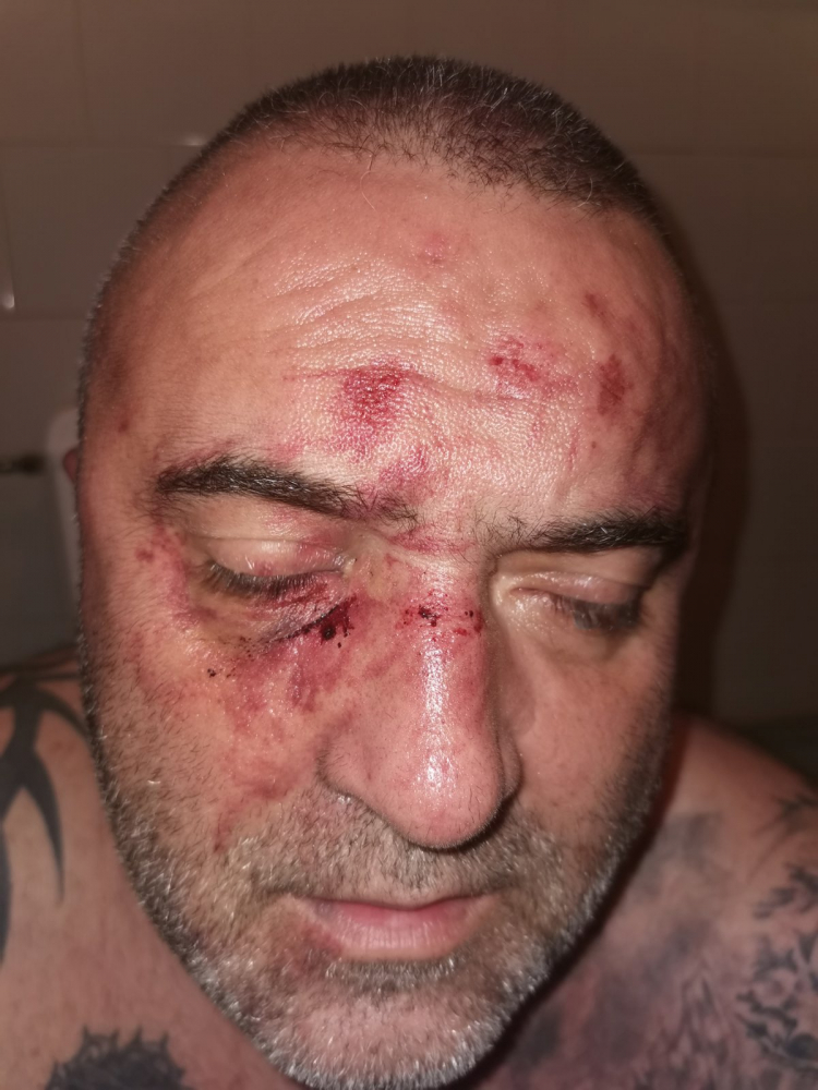 Зловещи подробности за Ради Дългия, пребит брутално от общинар на Марешки ВИДЕО 18+