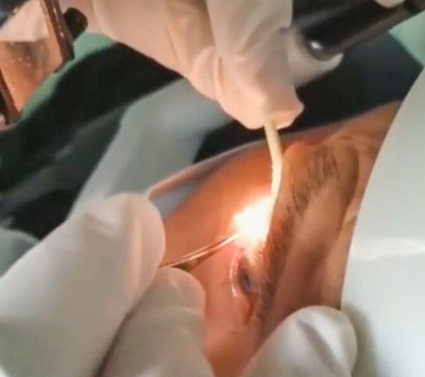 Лекар извади 20 живи червеи от окото на пациент! ВИДЕО 18+