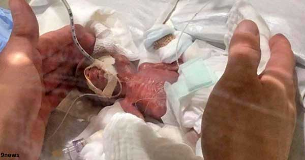 В Япония се роди най-малкото бебе – само 268 грама. И вече е изписано!