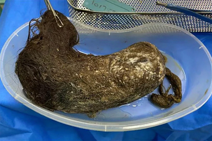 Ужасяващо! Огромна топка коса разкъса стомаха на момиче СНИМКА