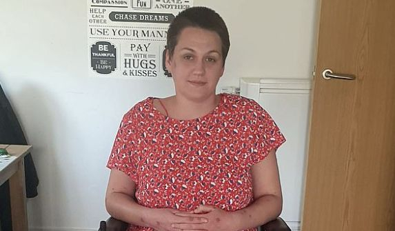 Жена се ваксинира с "АстраЗенека" и се покри с ужасяващи мехури СНИМКИ 18+