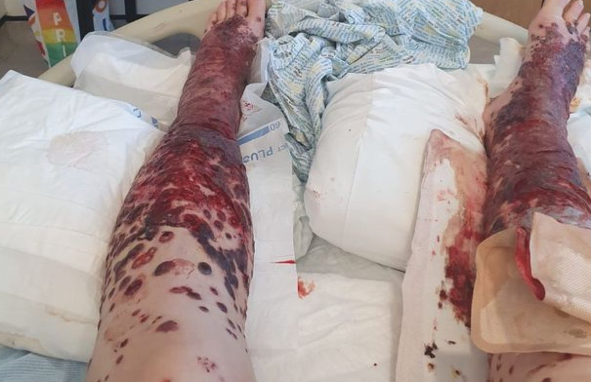 Жена се ваксинира с "АстраЗенека" и се покри с ужасяващи мехури СНИМКИ 18+