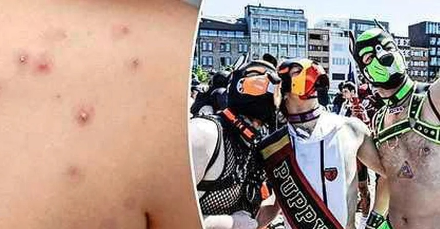 Висш съветник от СЗО: Големи партита на хомосексуалисти донесоха маймунската шарка в Европа