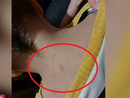 5-г. момче се прибра със синини от детската градина, а педагожките дадоха странно обяснение ВИДЕО