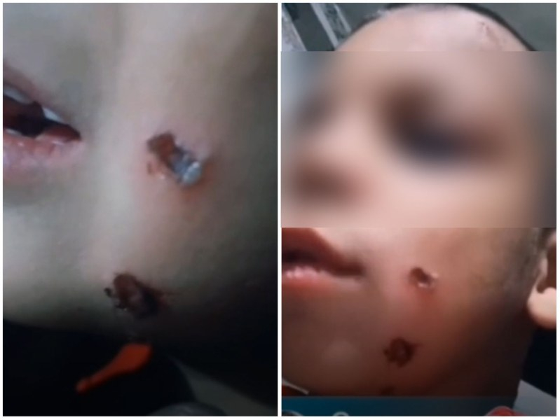 Прокуратурата със спешни действия заради бруталните кадри на дете с прогорени бузки 