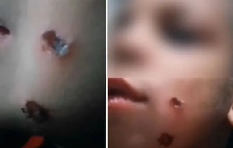 Нови разкрития за бруталните СНИМКИ 18+ на детето с прогорени бузки