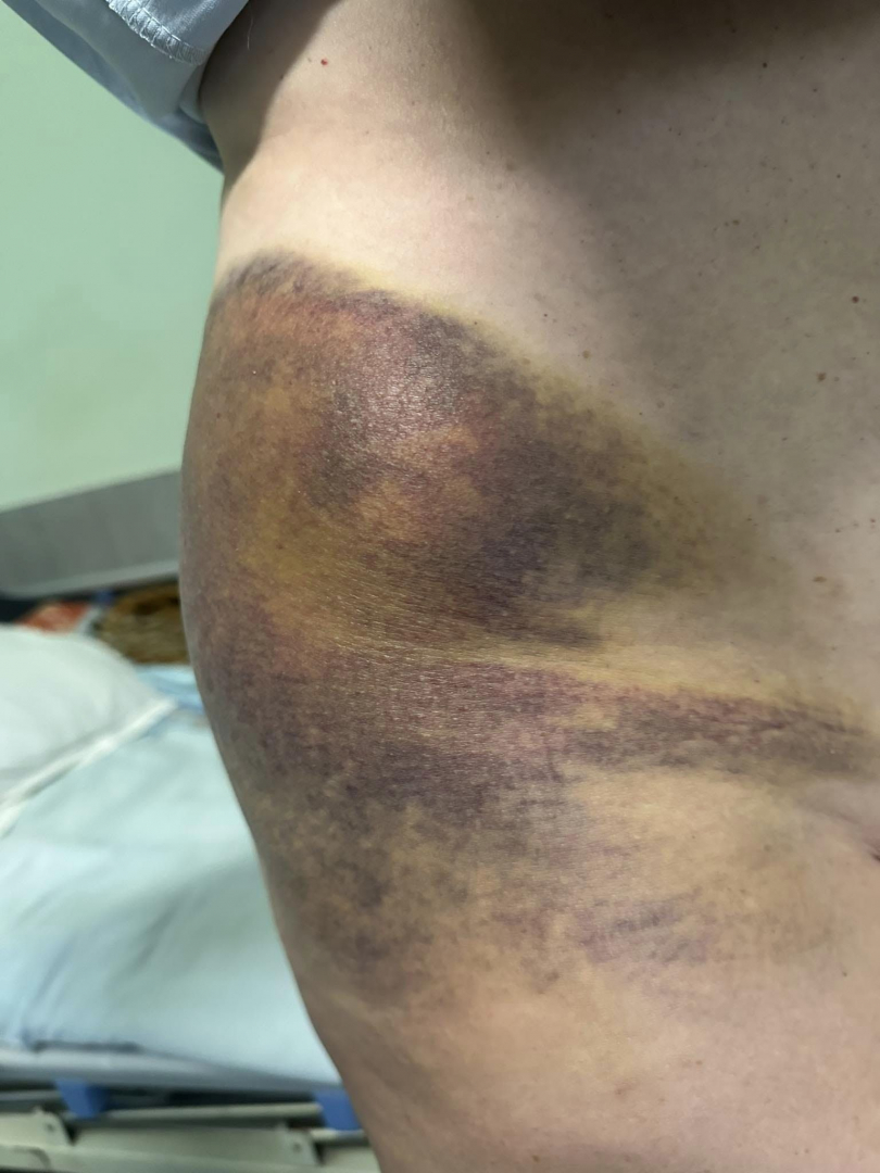 Тъщата на спипания на калъп кмет на Цалапица показа СТРАШНИ СНИМКИ 18+ 
