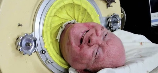 Тъжна вест: Почина легендарният мъж „с железния бял дроб” ВИДЕО