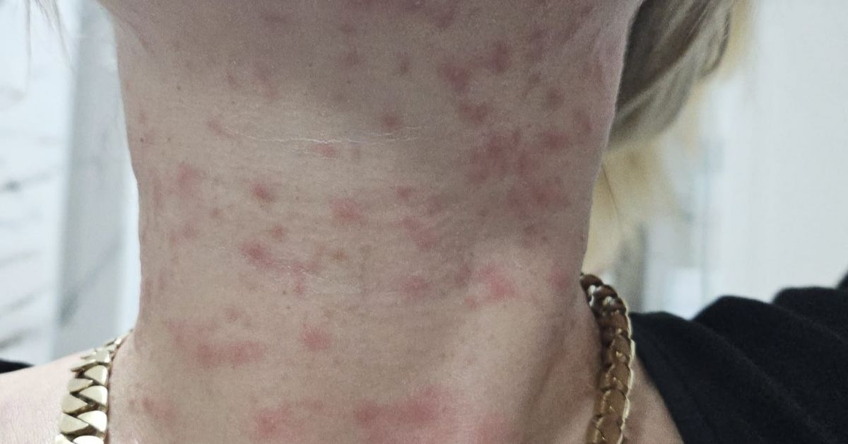 Страшни СНИМКИ! Ето какво причинила борова процесионка на бременната жена от Дупница