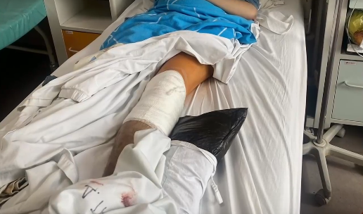 Удареният от тротинетка Матей ще прекара цял живот с 40 см желязо в крака си СНИМКИ 18+